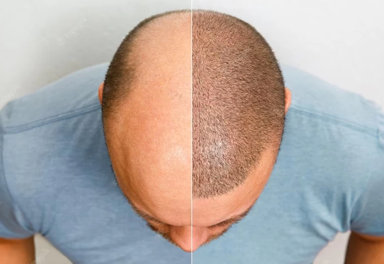 Advanced FUE Techniques