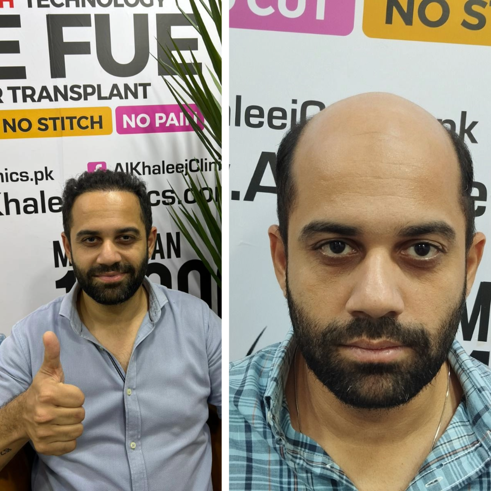 Before and After FUE Hair Transplant