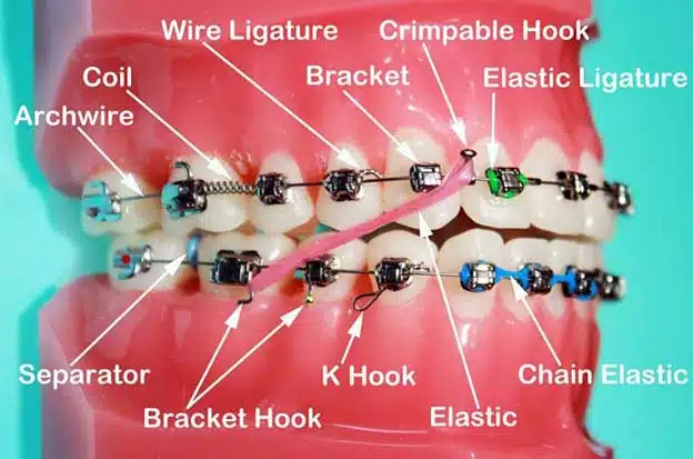 Close-up of dental braces