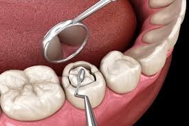 Dental fillings and tooth restoration in Karachi at Alkhaleej Smile Clinic