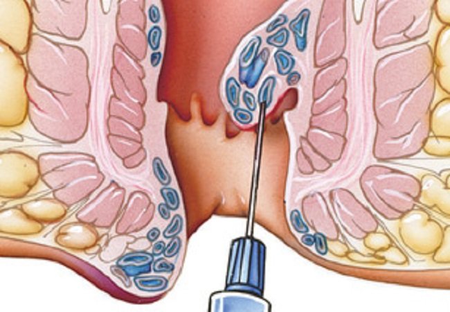 Laser Hemorrhoid Procedure Illustration
