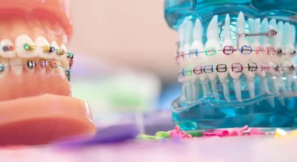 Orthodontics braces and Invisalign treatment in Karachi