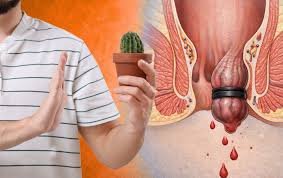 Rubber Band Ligation Medical Diagram