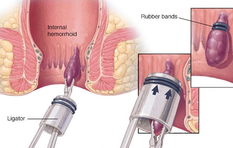 Stapled Hemorrhoidopexy Visual Illustration