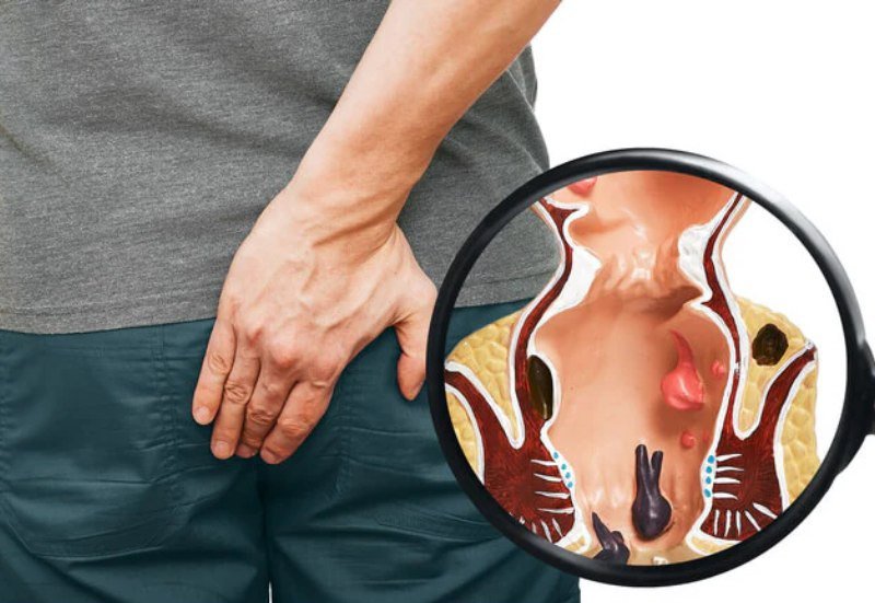 Medical illustration showing the anatomy of internal and external hemorrhoids