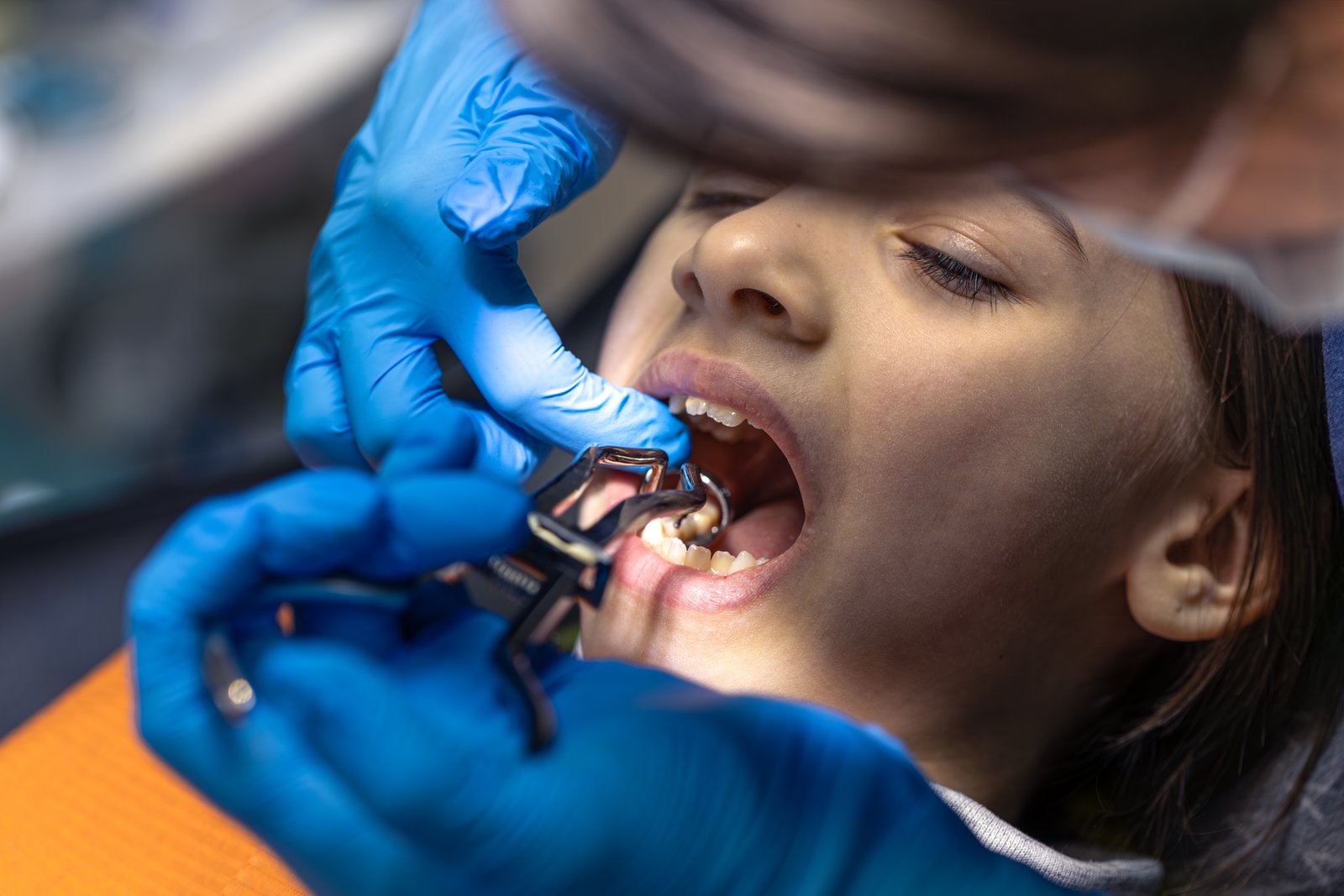 Dental fillings and tooth restoration in Karachi at Alkhaleej Smile Clinic