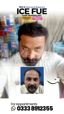 Hair Transplant Before After Results — AlKhaleej Clinics Karachi