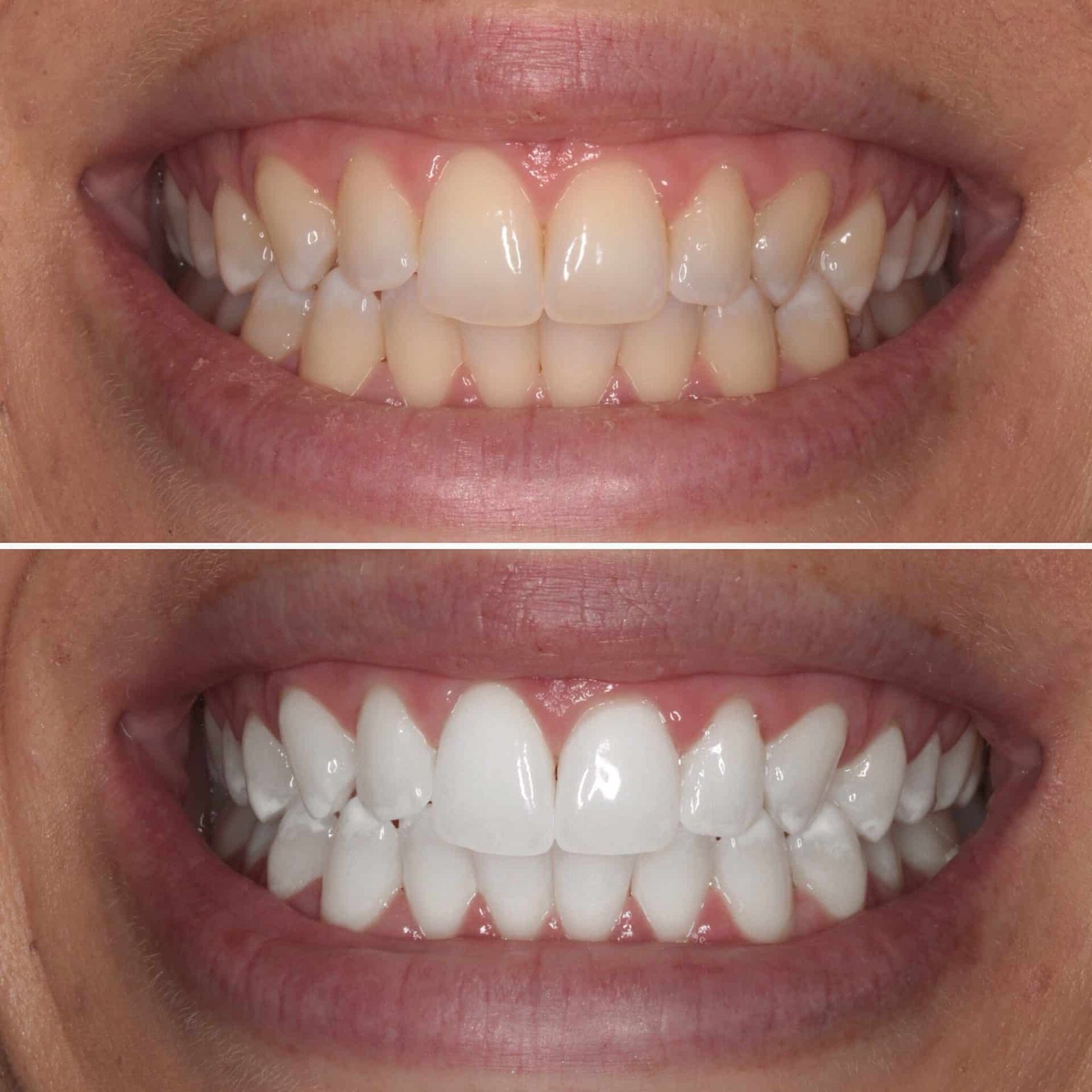Teeth whitening before and after – Alkhaleej Smile Clinic Karachi