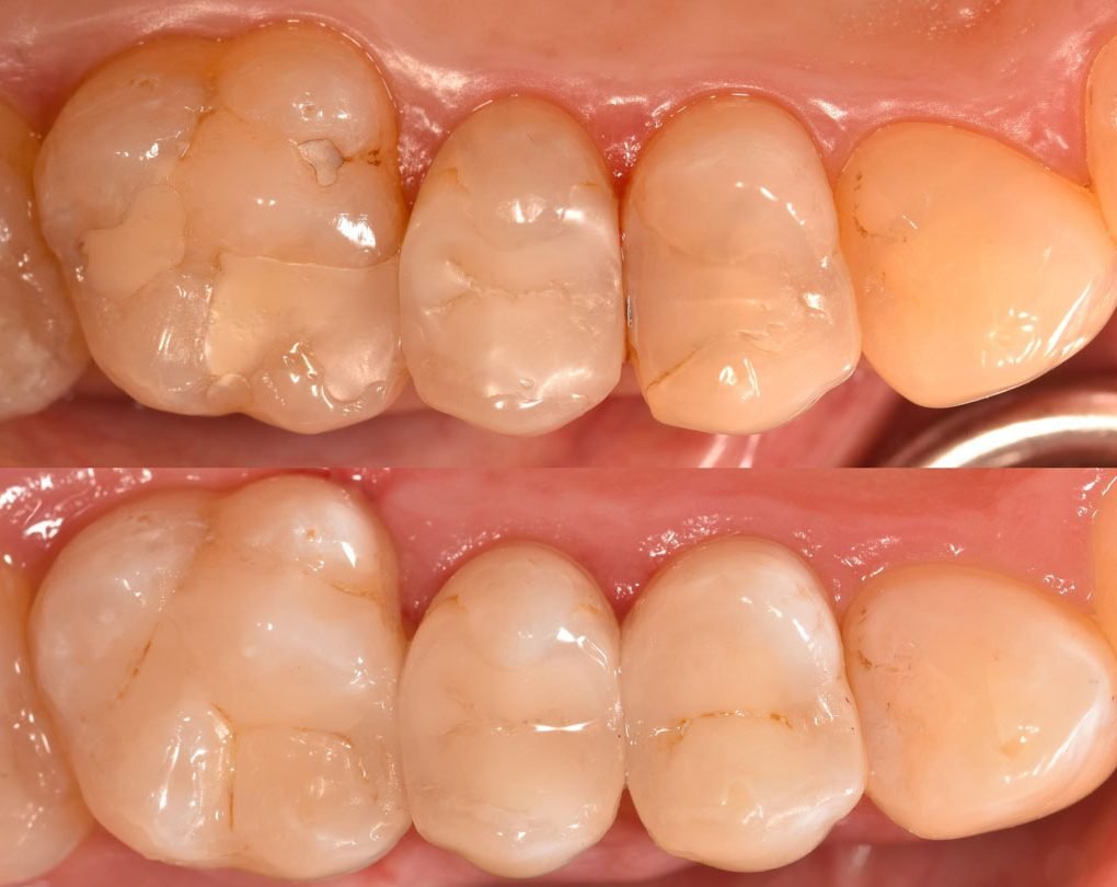 Cavity restoration before and after – Alkhaleej Smile Clinic Karachi
