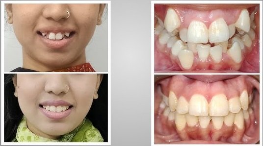Dental braces before and after – Alkhaleej Smile Clinic Karachi