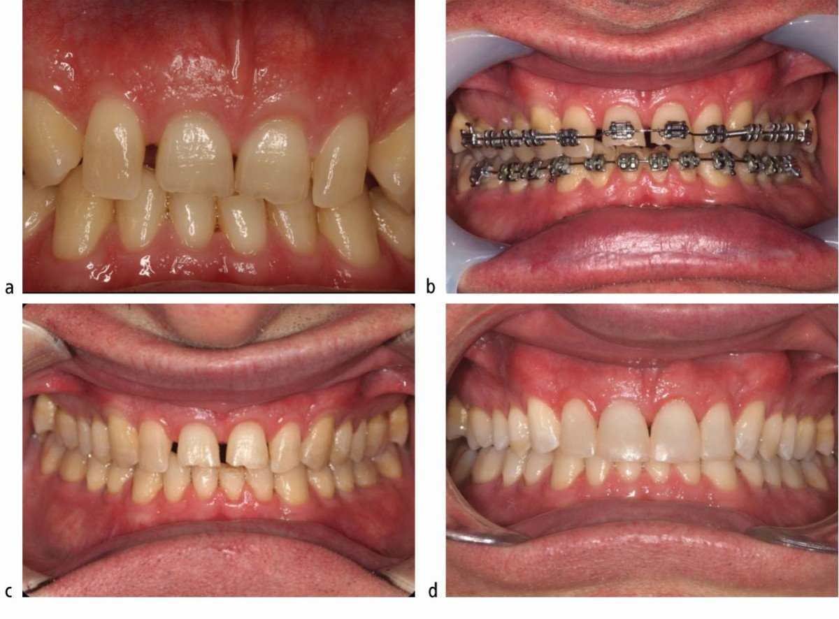 Orthodontic correction before and after – Alkhaleej Smile Clinic Karachi