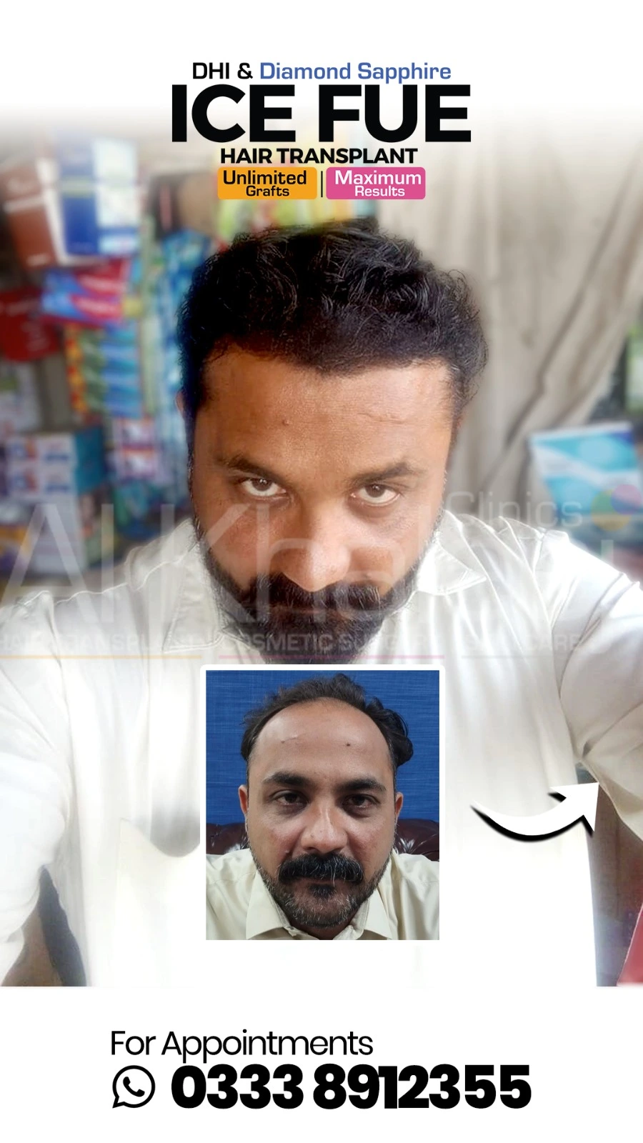 Hair Transplant Before After Results — AlKhaleej Clinics Karachi