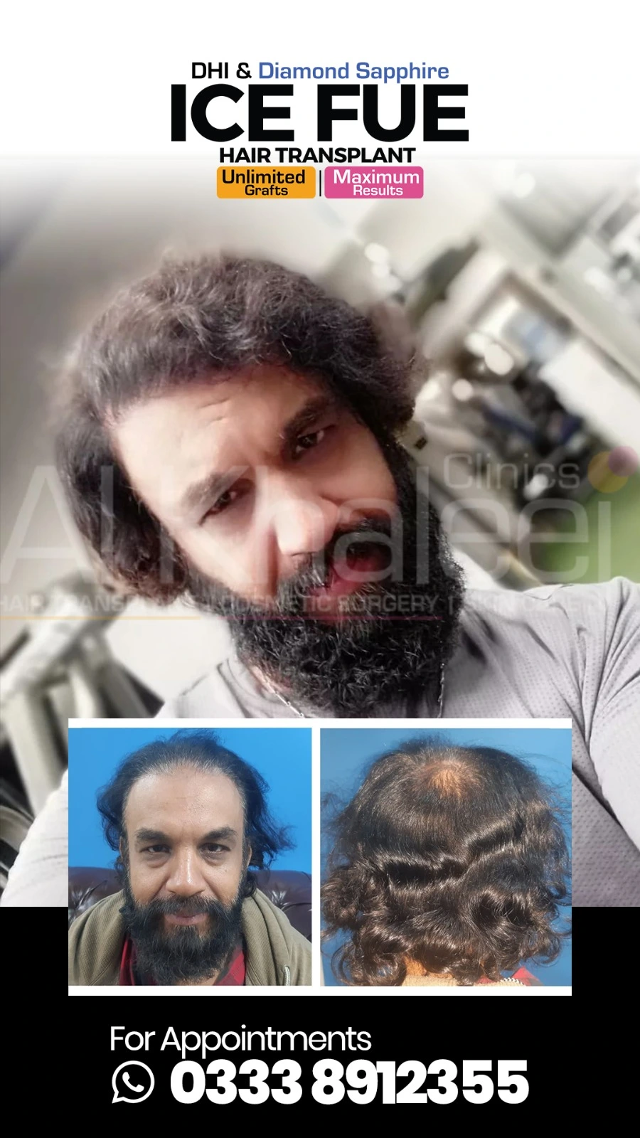 Skin Whitening Before After Result — Dermatologist Karachi